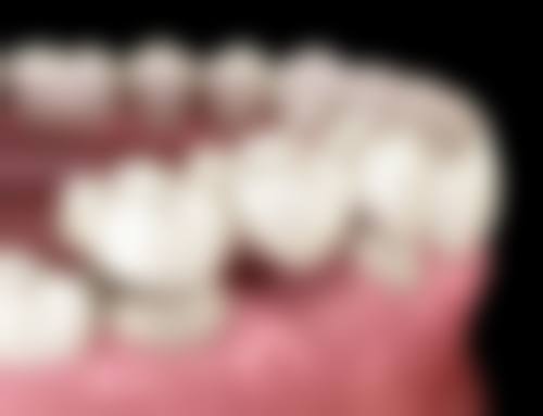 广州广大口腔：术后护理简单，长期维护口腔健康