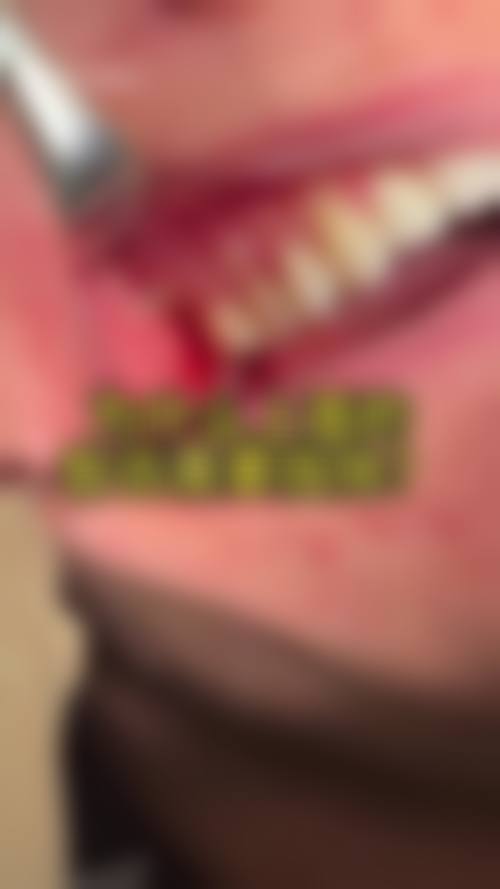 三、常州二院拔智齿的配套检查费用是多少？