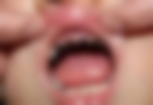 第一次根管治疗后牙齿还会疼的判断方法