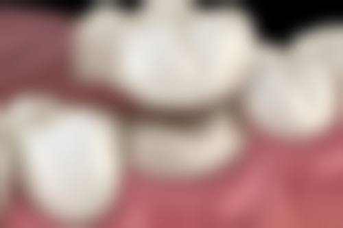 烤瓷牙金属材质对口腔健康的影响