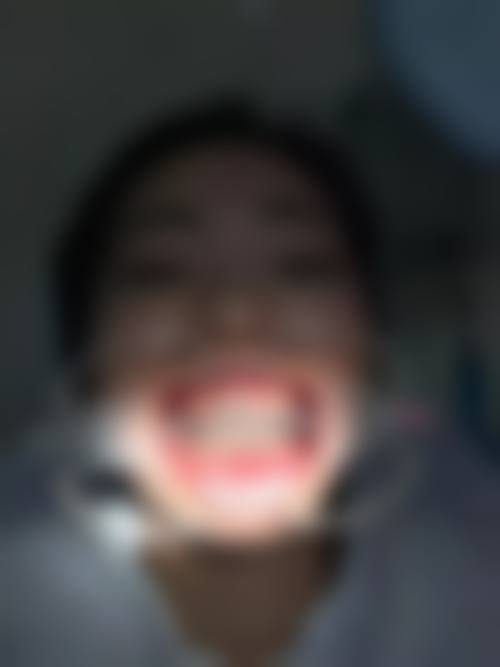 20岁牙齿能不能矫正？成年后矫正依然有效，但需1 - 3年且要戴保持器 
