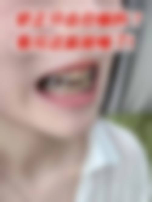 二、不同原因导致的牙歪如何矫正