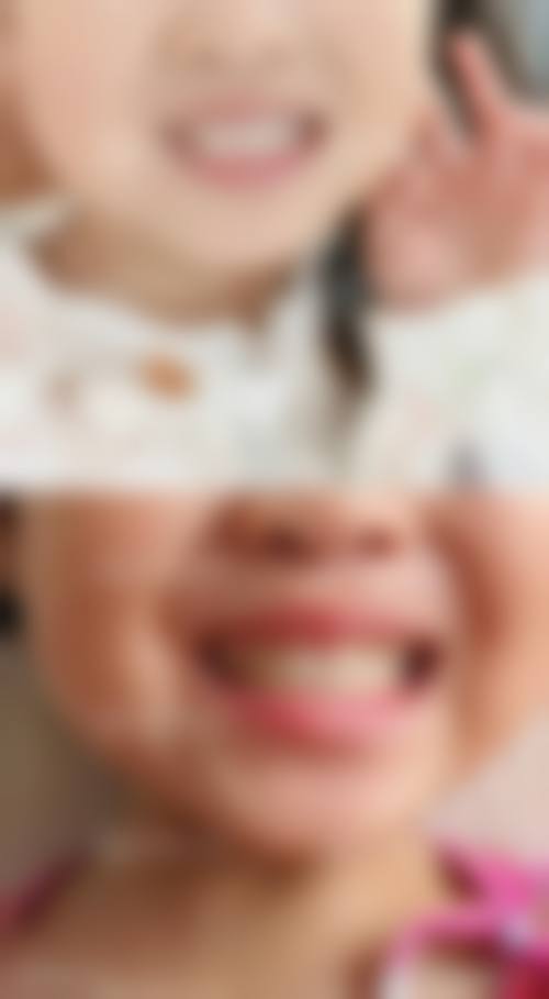矫正牙齿反颌：恒牙期矫治器选择