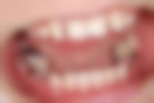 过早装全瓷牙的风险