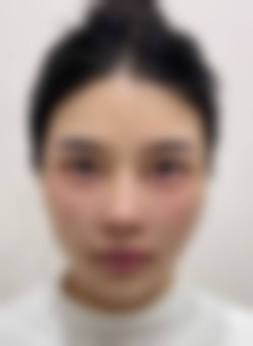 优惠活动详情：面部年轻化限时体验